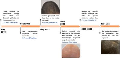 Cyclosporine-induced alopecia:a case report, FDA adverse event reporting system analysis and literature assessment